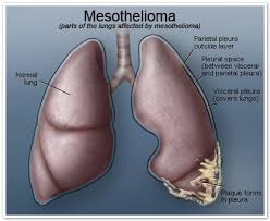 stages of mesothelioma disease