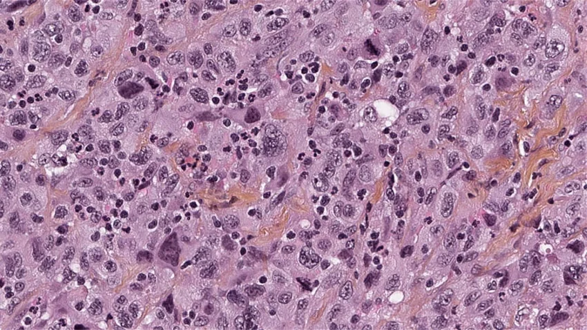 peritoneal mesothelioma pathology outlines