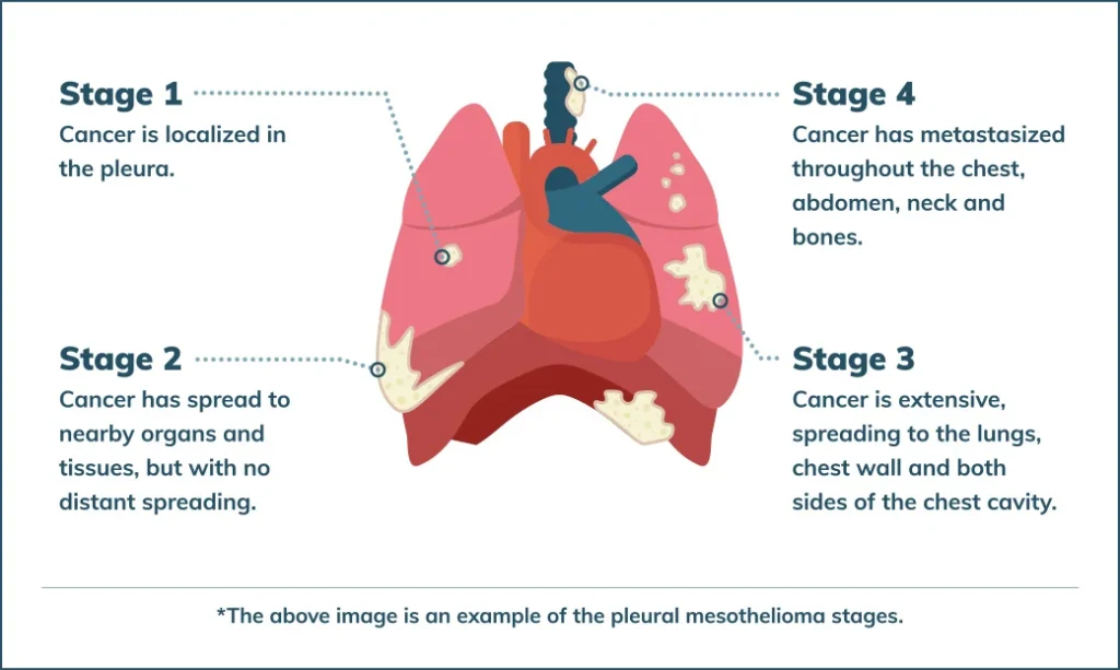 Stage 4 Mesothelioma Prognosis