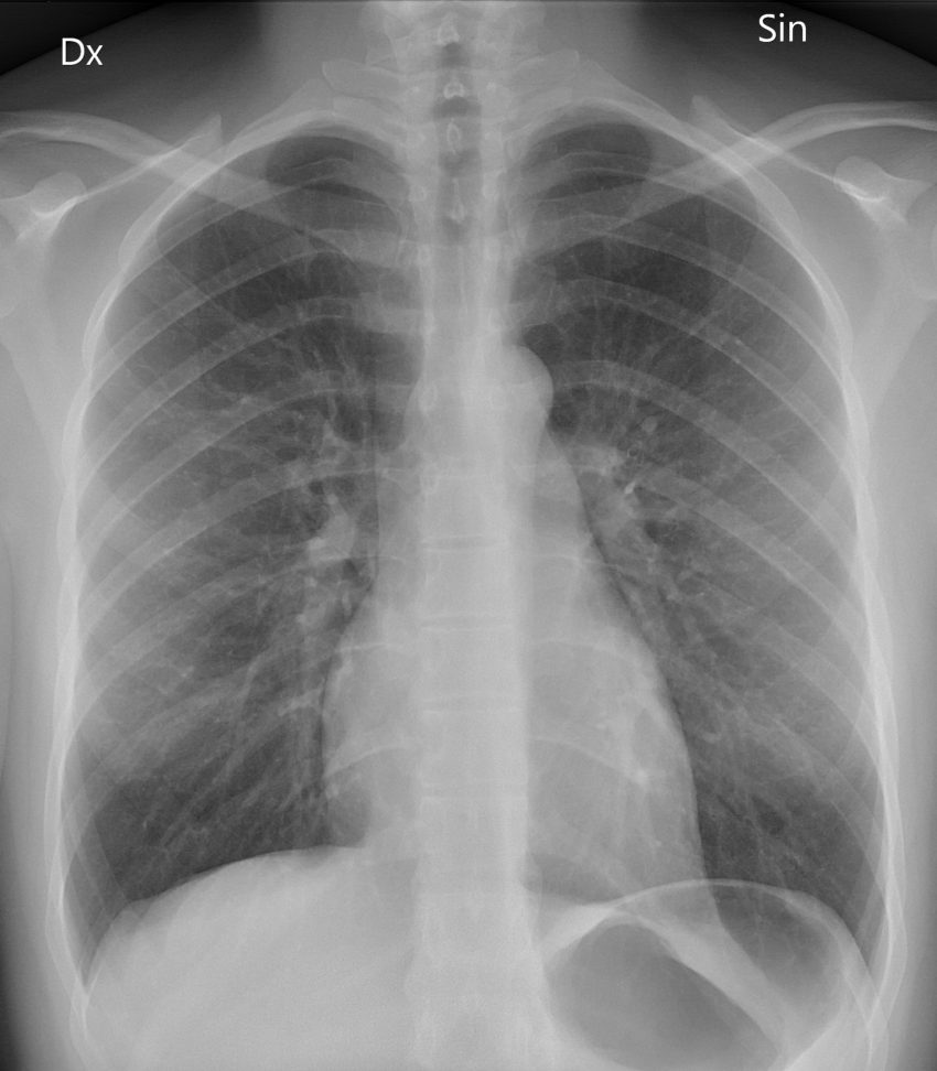 Lung X-rays