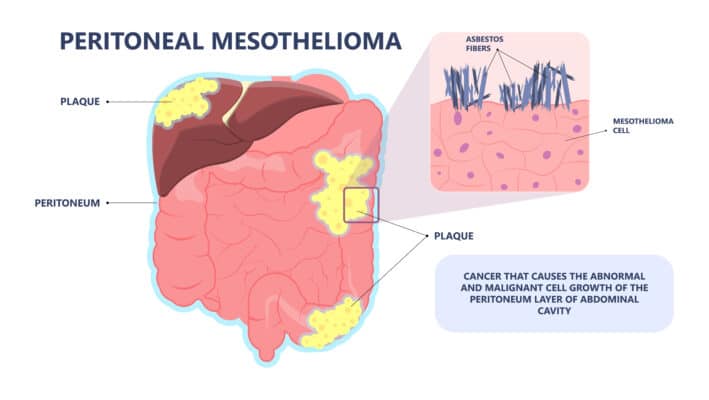 mesothelioma what causes it