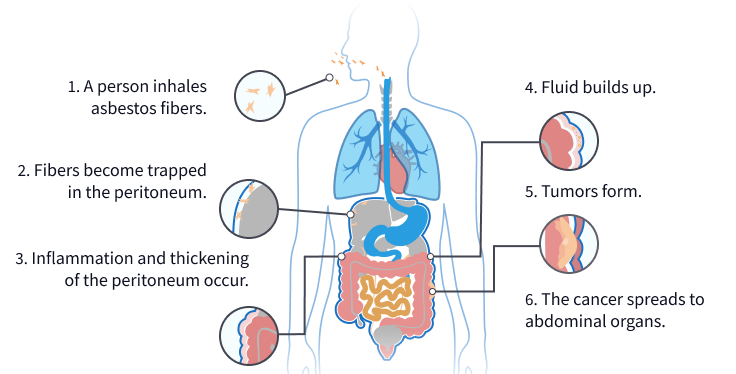 peritoneal mesothelioma clinical trials