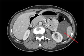 cystic mesothelioma of the peritoneum