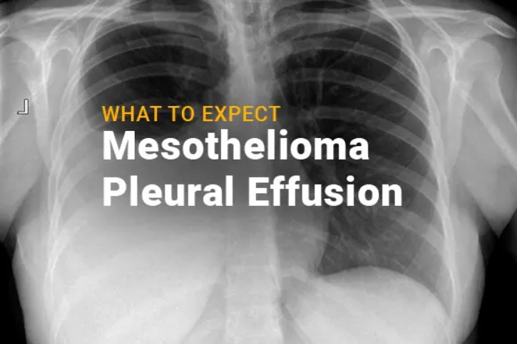 malignant mesothelioma pleural effusion