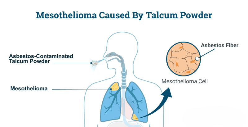 mesothelioma associated with the use of cosmetic talc