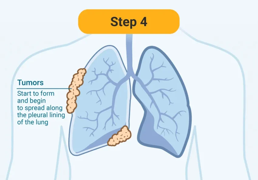 Navigating Stage 4 Mesothelioma: A Comprehensive Guide