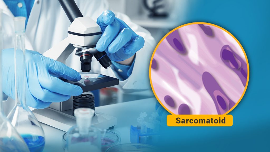 Sarcomatoid Mesothelioma Pathology