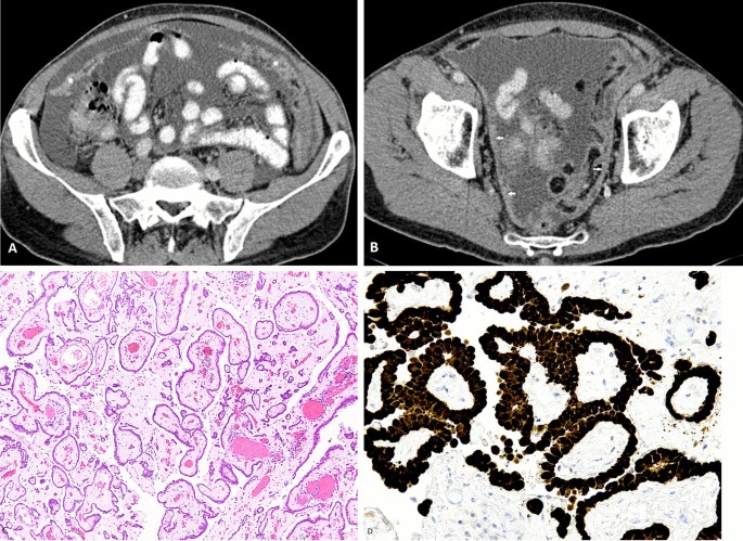 primary peritoneal mesothelioma radiology