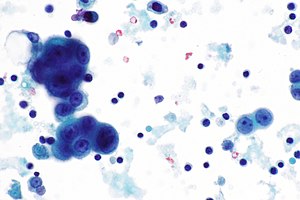 peritoneal mesothelioma pathology outlines