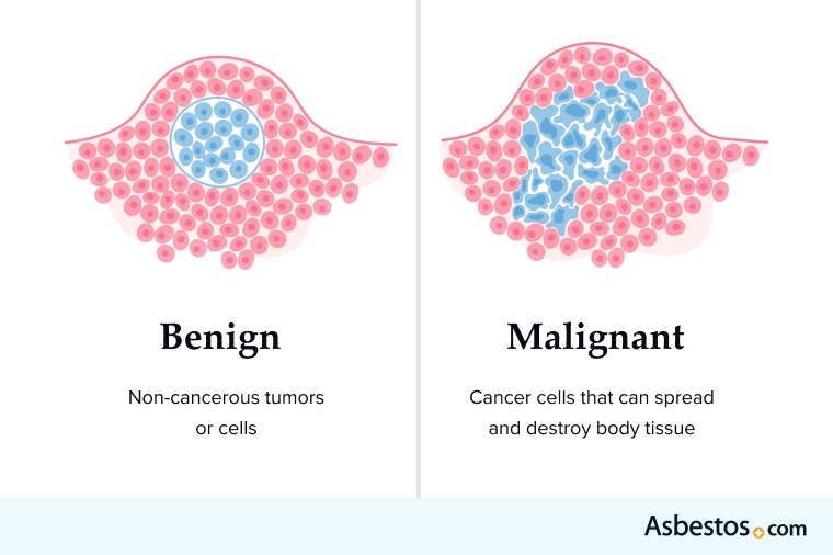 malignant mesothelioma life expectancy