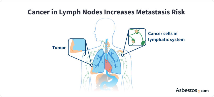 mesothelioma cancer life expectancy