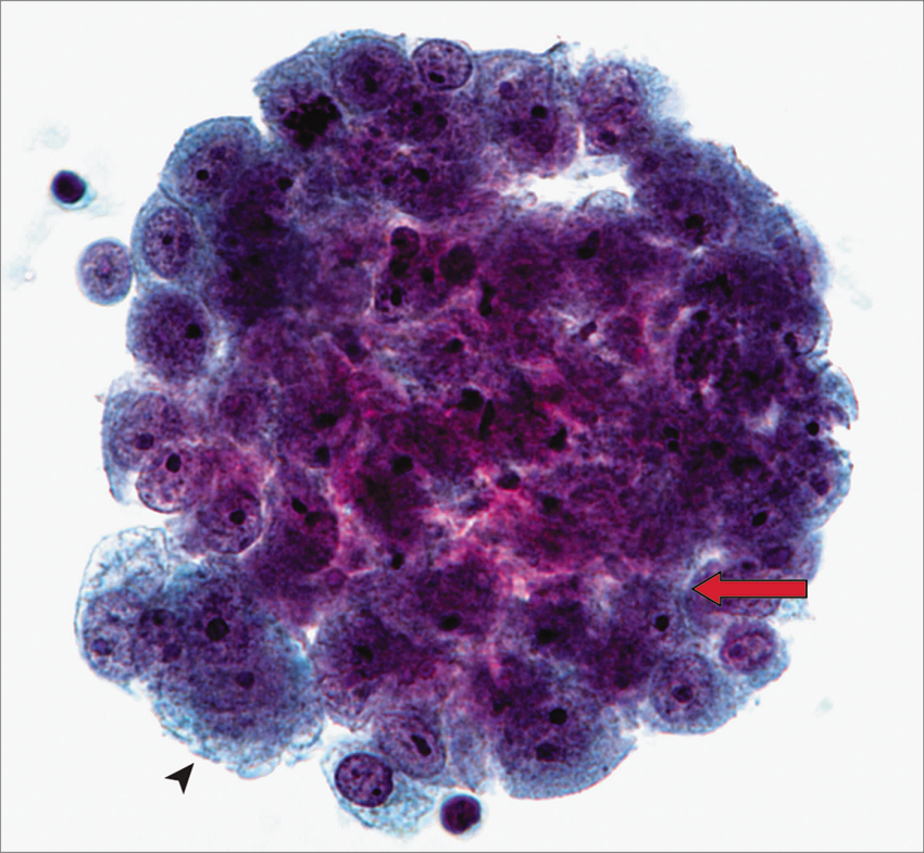 epithelioid mesothelioma pathology outlines