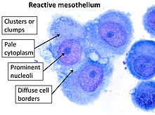 mesothelial cell in pleural fluid