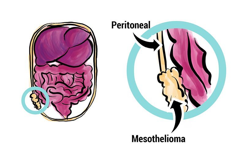 malignant peritoneal mesothelioma treatment