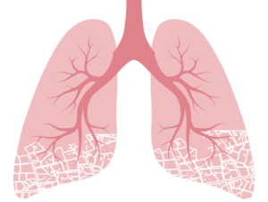 mesothelioma final days of life