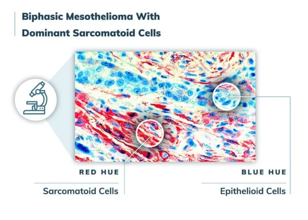 sarcomatoid mesothelioma survival rate