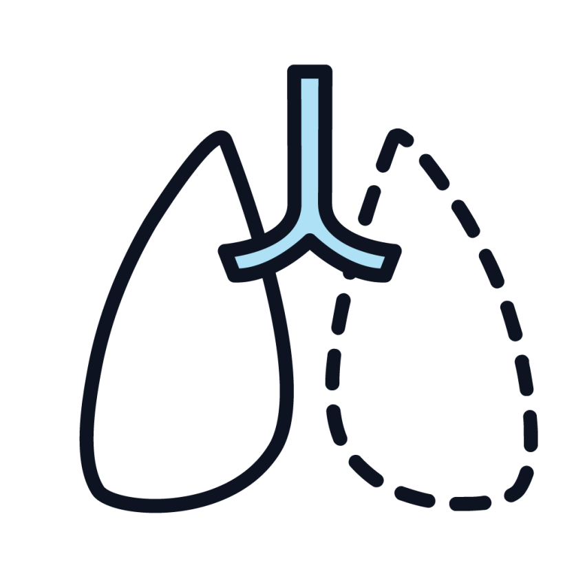 mesothelioma fluid in lungs