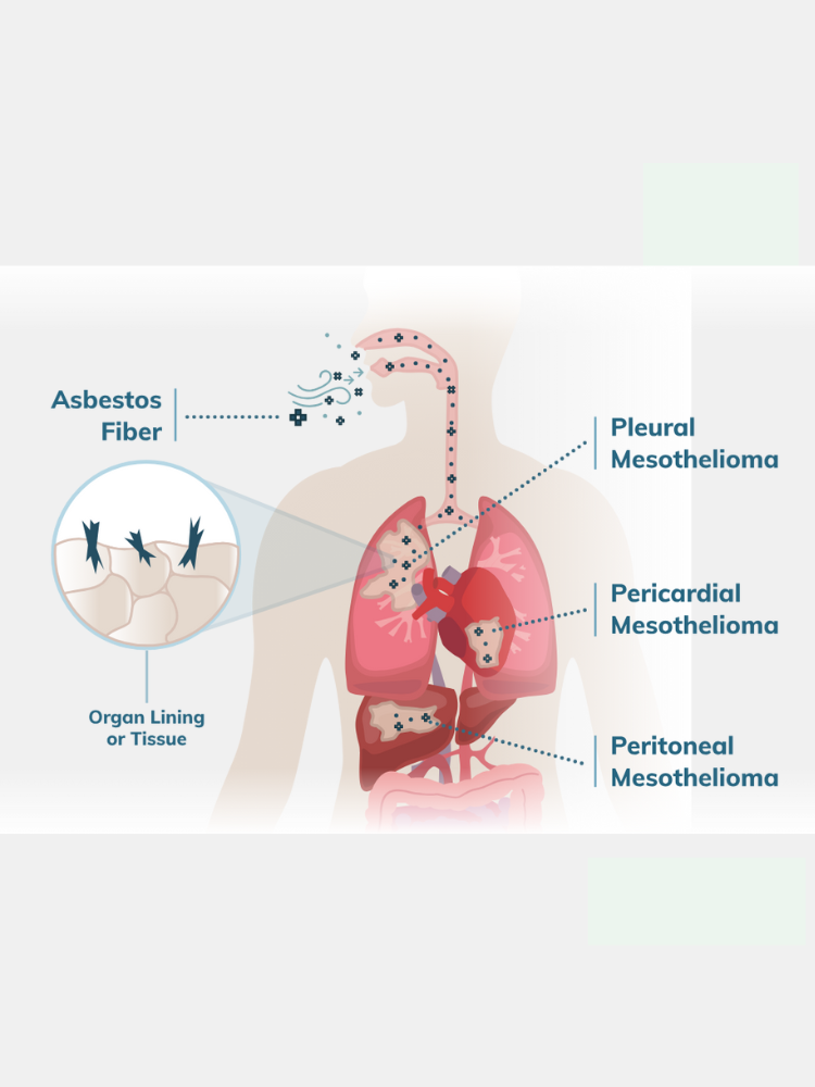 mesothelioma cancer what is it