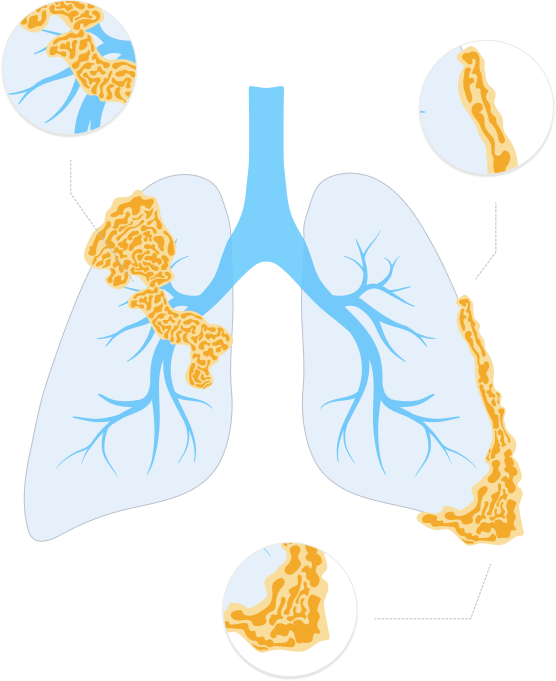 pleural mesothelioma metastasis sites