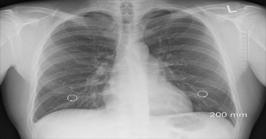 pleural effusion and mesothelioma