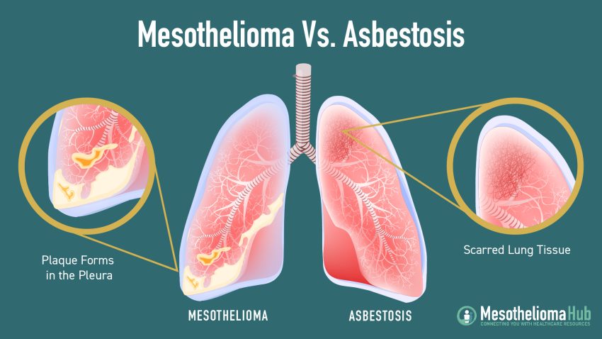 mesothelioma and asbestos lawyers