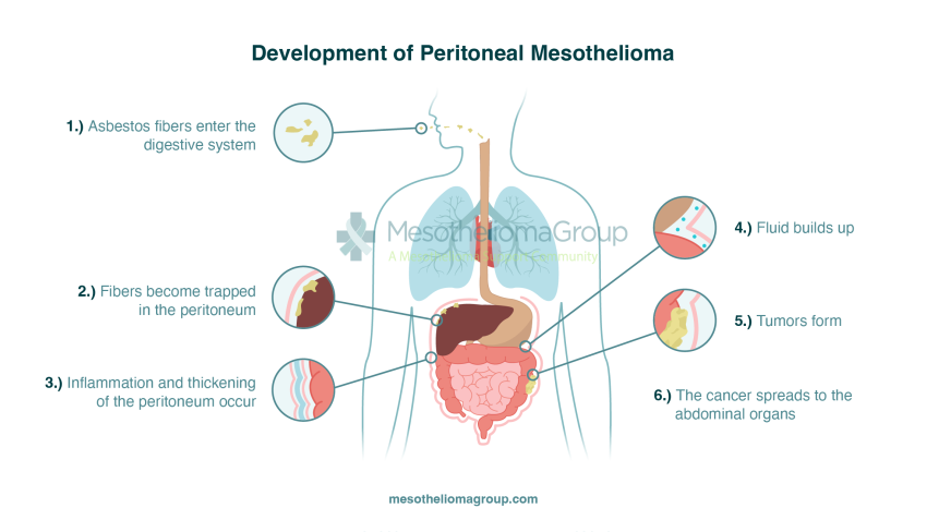 abdominal mesothelioma survival rates