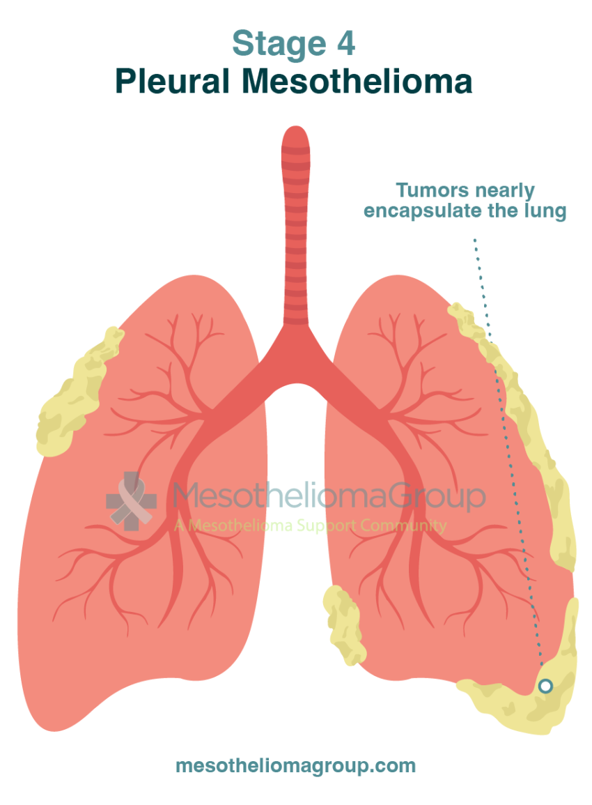 mesothelioma pleural effusion staging