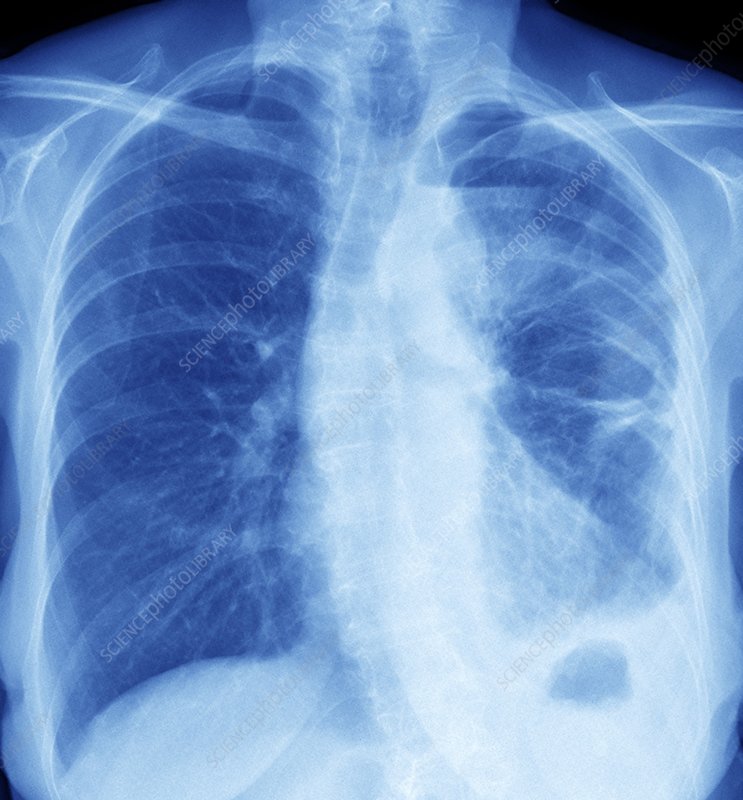 mesothelioma chest x ray