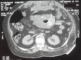 cystic mesothelioma of the peritoneum