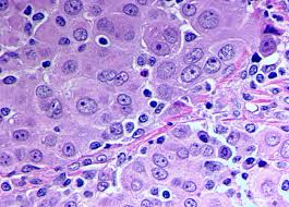 epithelial mesothelioma survival rate