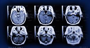 mesothelioma metastasis to brain