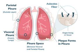 mesothelioma stage 4 treatment