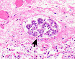 malignant mesothelioma pathology outlines