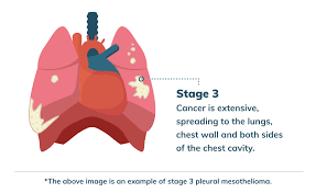 stage 3 mesothelioma life expectancy