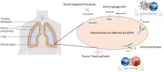 epithelial mesothelioma survival rate