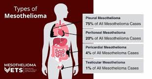 different types of mesothelioma