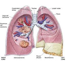 mesothelioma small cell lung cancer