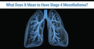 stage 4 mesothelioma prognosis