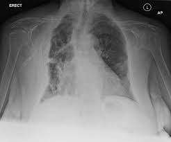 malignant pleural mesothelioma radiology