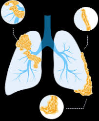 lung cancer asbestos mesothelioma