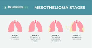 mesothelioma stage 4 survival rate