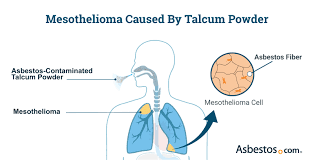 mesothelioma and talcum powder