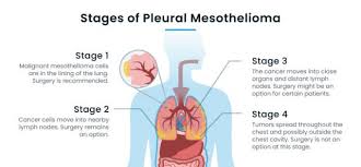 peritoneal mesothelioma stage 4