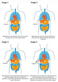 stage 4 pleural mesothelioma