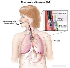 standard treatment for mesothelioma