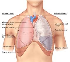 surgery for pleural mesothelioma