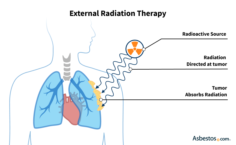 proton therapy for mesothelioma