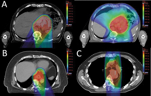 stage 4 pleural mesothelioma