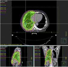 prognosis for mesothelioma patients