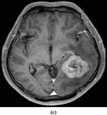 mesothelioma metastasis to brain